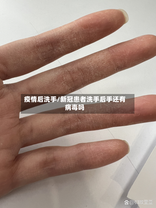疫情后洗手/新冠患者洗手后手还有病毒吗-第2张图片